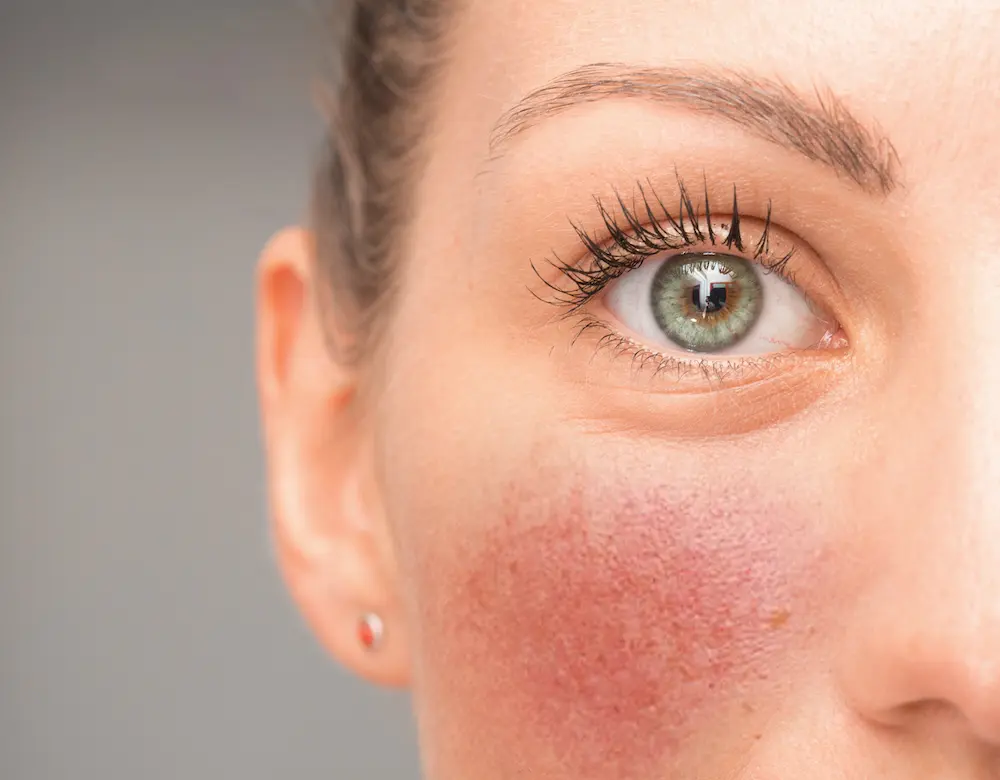 Rosacea